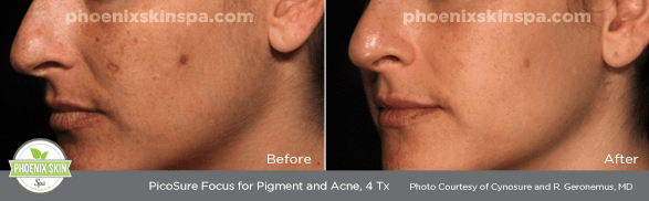 Heel risico Skim PicoSure FOCUS Skin Rejuvenation – Phoenix Skin Spa