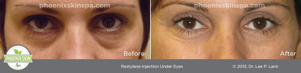 Restylane before and after_phoenixskinspa